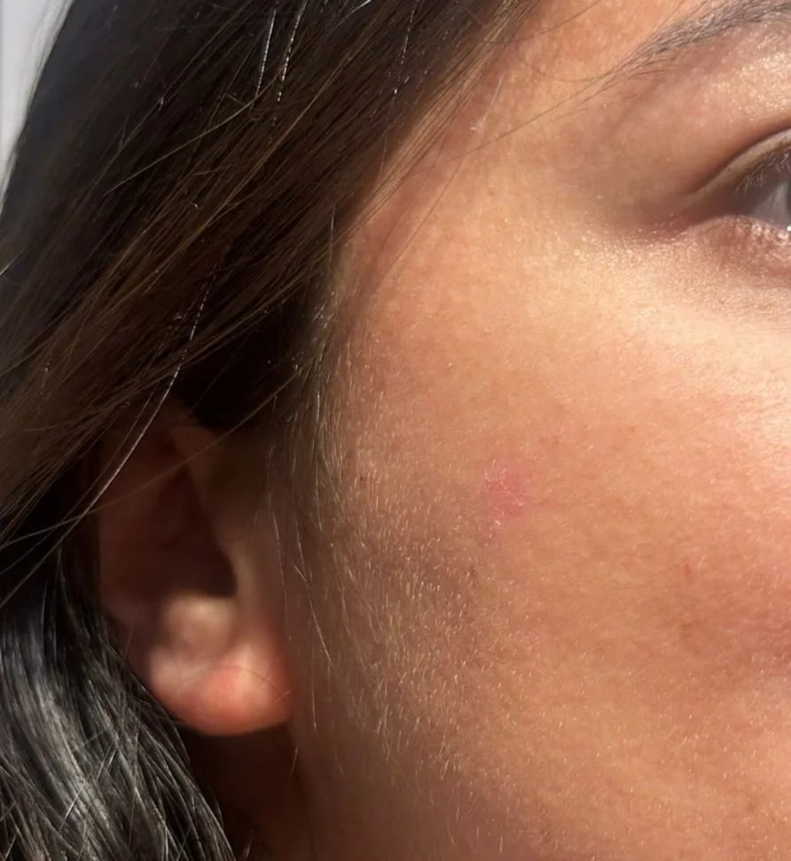 Skin tag removal results on neck area - after