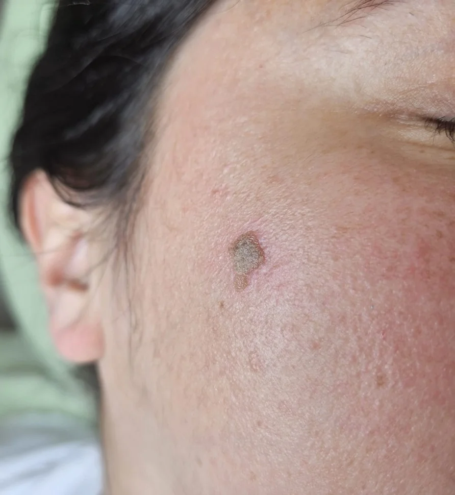 Skin tag removal results on neck area - before